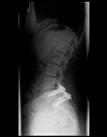 Spondylolisthese II Spondylolisthese II